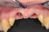 5 - situazione finale con monconi dentari e implantari