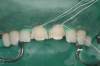 4 - preparazione dei denti e inizio cementazione