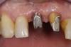 3 - moncone implantare a destra e moncone dentario a sinistra