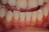 1 - dente incisivo laterale inferiore destro storto