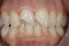 3 - particolare dei denti fratturati