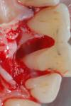 6 apertura chirurgica e completa pulizia delle radici dentarie (2)