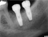 5 - rx dopo l'inserimento degli impianti