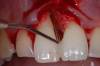 6 apertura chirurgica e completa pulizia delle radici dentarie (1)